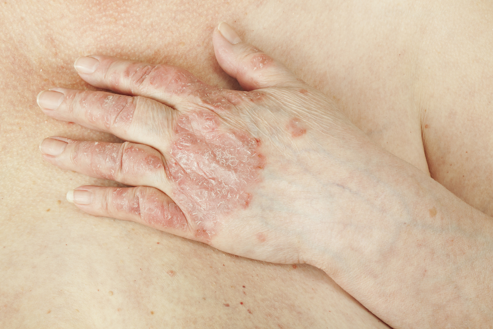 10 Remèdes Maison contre le Psoriasis | ActiveBeat 10 Remèdes Maison contre le Psoriasis | ActiveBeat