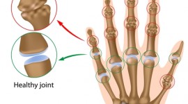 Signs & Symptoms of Osteoarthritis