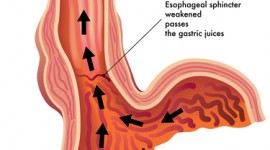 What is Gerd?