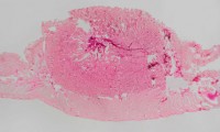 Cancer Pill Approved for Treatment of Intestinal Tumors