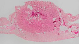 Cancer Pill Approved for Treatment of Intestinal Tumors