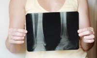 Vitamin D & Calcium Offer Little Benefits for Elderly Bones
