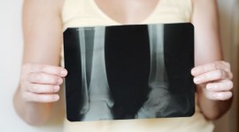 Vitamin D & Calcium Offer Little Benefits for Elderly Bones