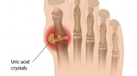 10 Common Symptoms of Gout