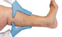 10 Ways to Eliminate Varicose Veins