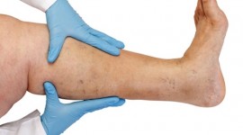 10 Ways to Eliminate Varicose Veins