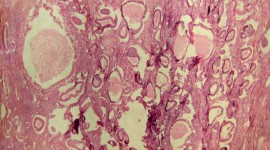 9 Common Classifications of Polyps