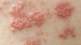 10 Possible Causes For Those Bumps on Your Skin