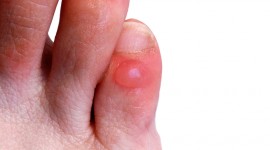 10 Ways to Make a Blister Heal Faster