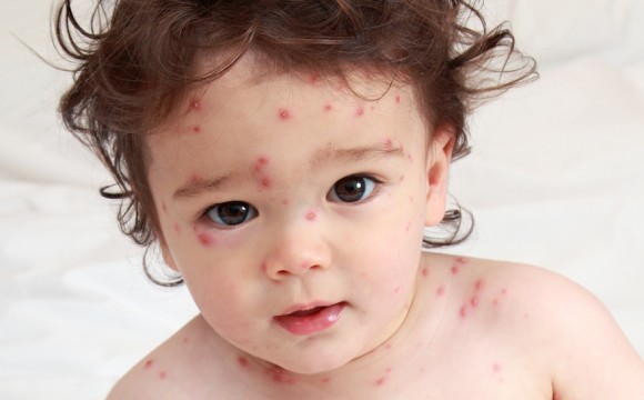 Chicken Pox Symptoms: 8 Signs of Chicken Pox