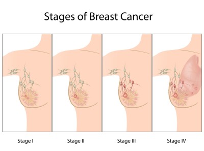 More detailed findings confirm that coffee protects against breast cancer recurrence