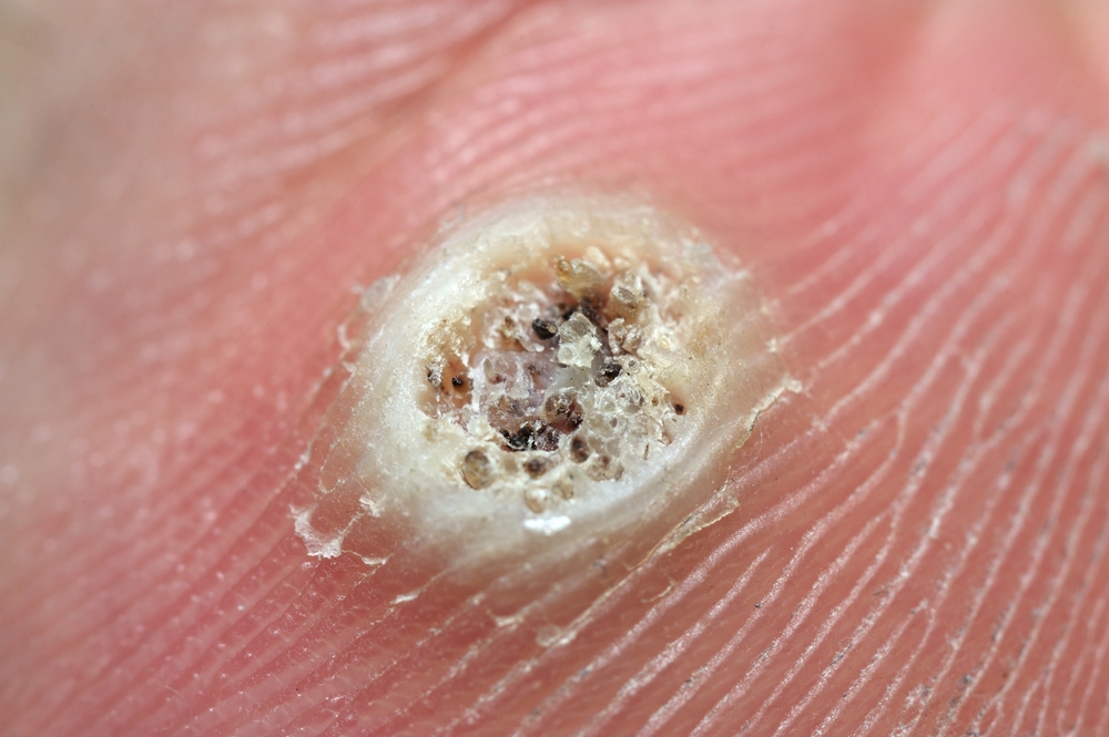 Warts Pictures | Photos & Images - What Do Warts Look Like?