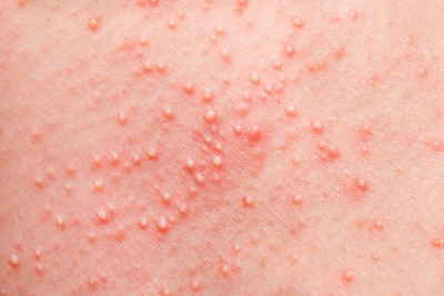 How to Spot Summers’ Most Common Skin Rashes | ActiveBeat