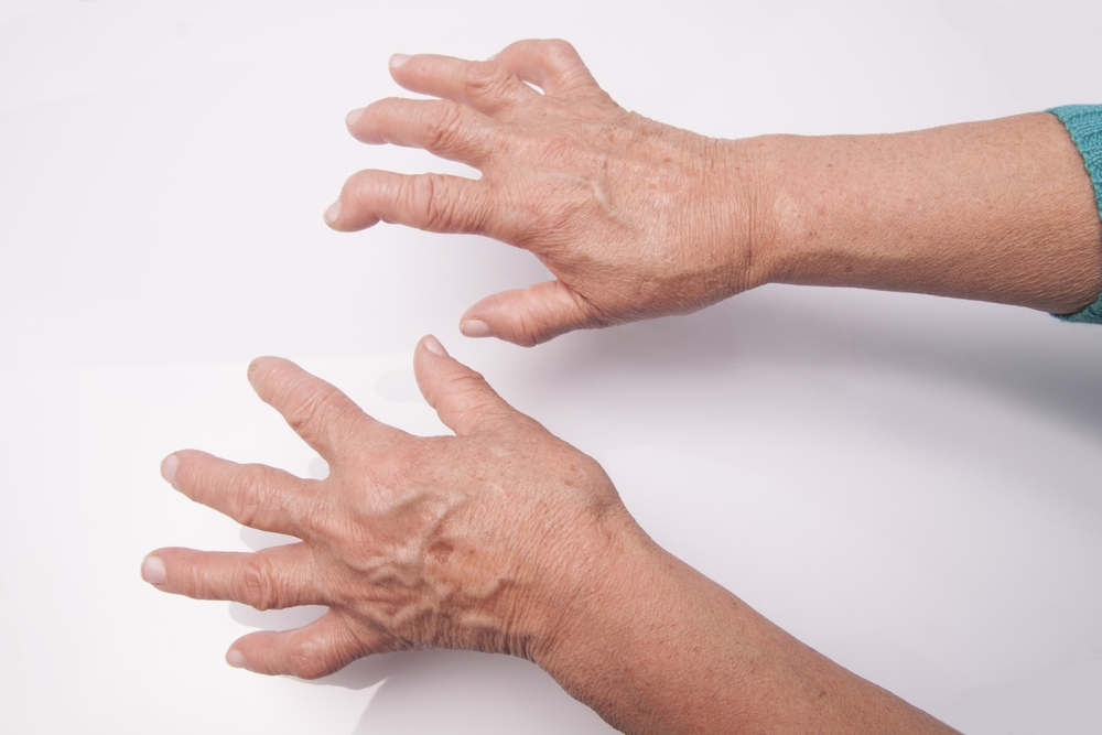 Noutăţi în tratamentul artritei reumatoide - Viața Medicală