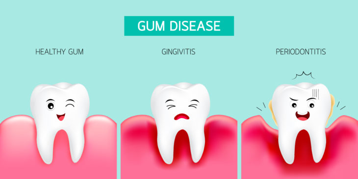 Signs of Gum Disease You Should Never Ignore — Plus More Oral Health Facts